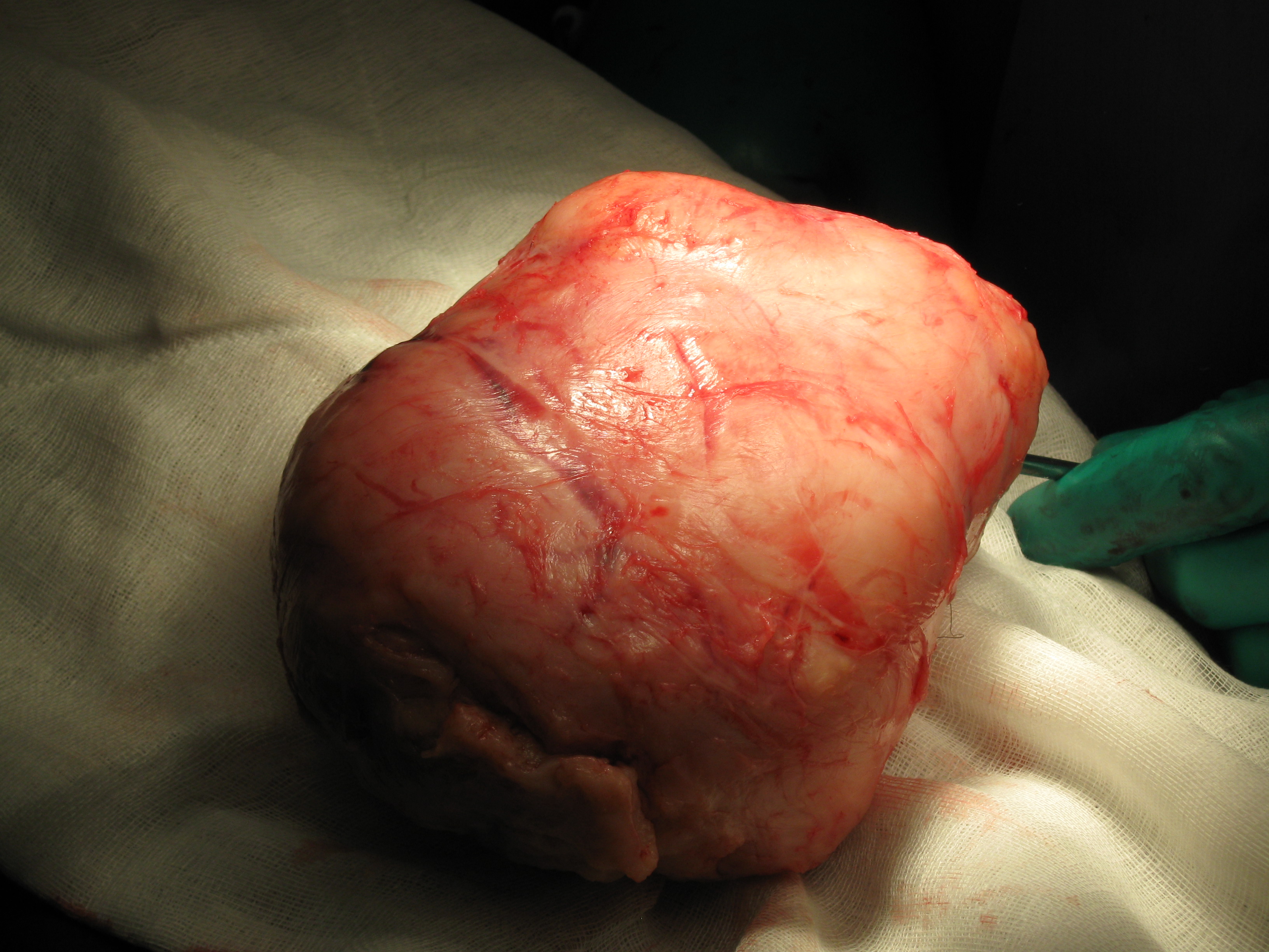 Fibroid Abdominal Myomectomy Serag Youssif (12)